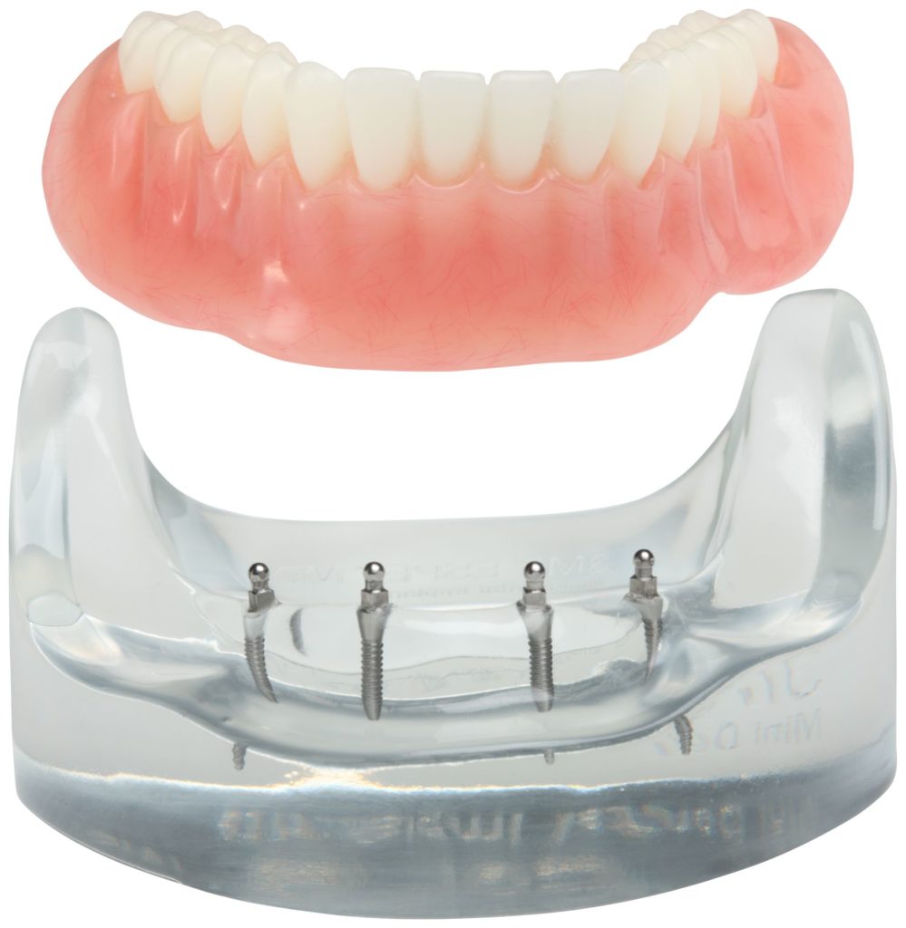 3M ESPE Mini-Implantate Modell